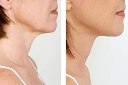 Neck Lift in Dubai