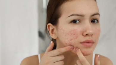 Acne 101: How Long Does a Pimple Last and How to Manage It