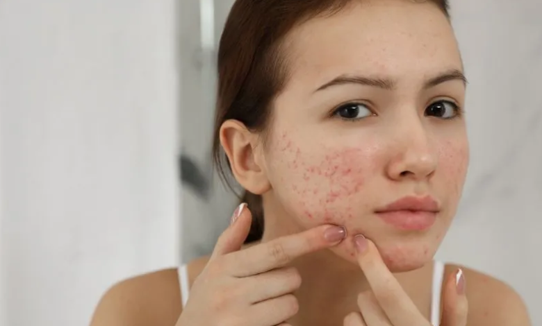 Acne 101: How Long Does a Pimple Last and How to Manage It